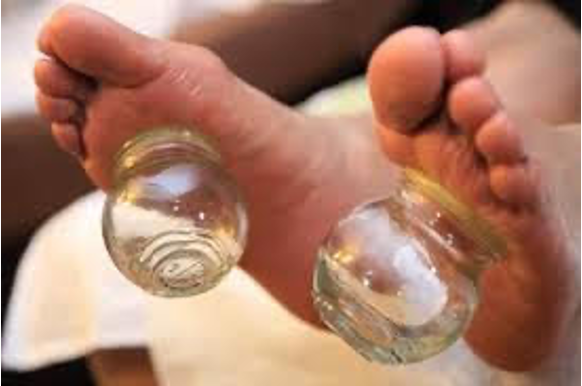 Cupping applied to the soles of the feet
