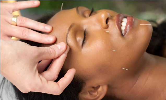 Acupuncture needles placed along the face and temple during a treatment